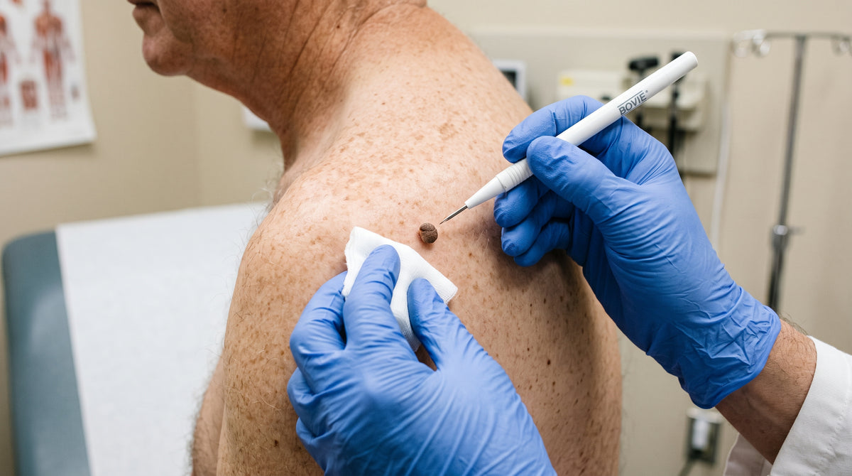 In-office skin tag removal: $150+ per tag. Insurance doesn’t cover it.